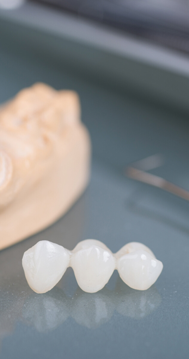 Dental Bridge and Implants