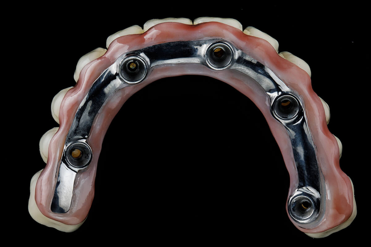 Dental-Bridges