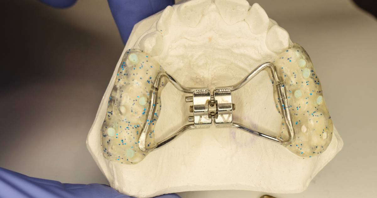 Palate Expanders