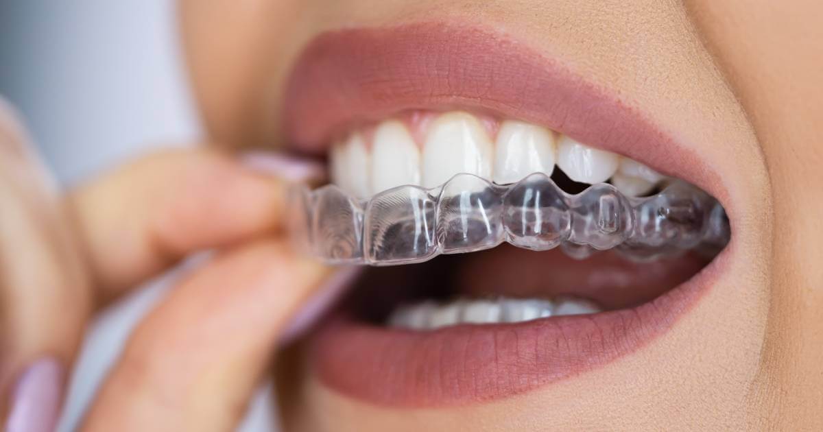 Invisalign Treatment